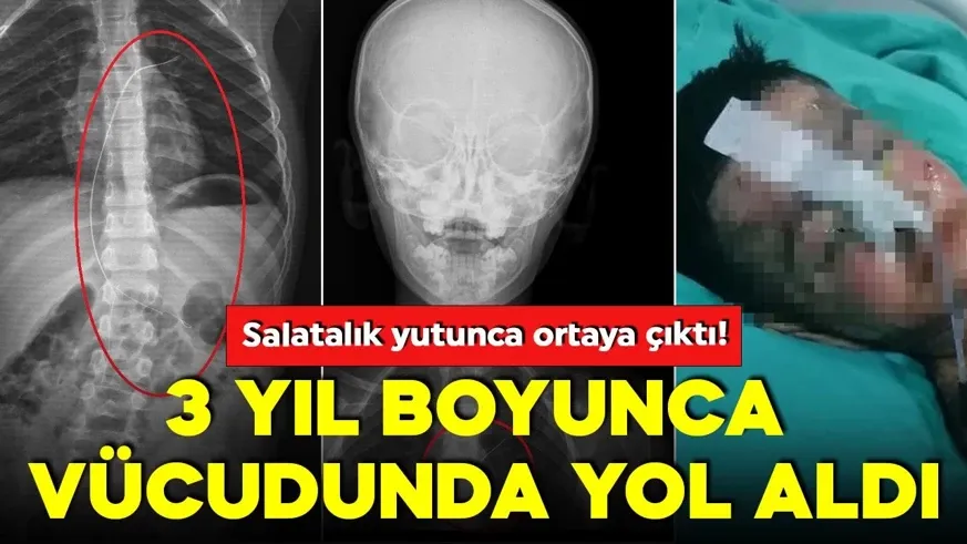 Salatalık yutunca ortaya çıktı! 3 yıl boyunca vücudunda yol aldı